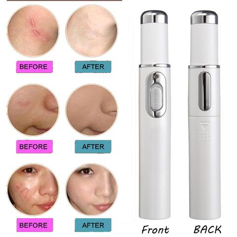 Blue Light Acne & Scar Treatment Pen